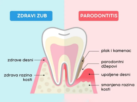 Gengivite e Parodontite